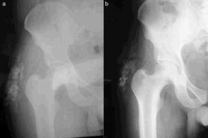 Imagen radiográfica comparativa de un paciente con CT después de 7 años de tratamiento con acetazolamida: 2a) Inicio del tratamiento (agosto 2008). 2b) Seguimiento del paciente (febrero 2015).