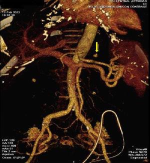 Imagen en TAC de un nódulo hiperdenso en la región posterior del fundus gástrico, compatible con seudoaneurisma de la arteria gástrica izquierda, con un hematoma subyacente.