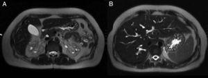 Colangiopancretografía por resonancia magnética: A) Quistes renales bilaterales. B) Enfermedad de Caroli en el hígado.