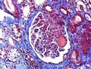 Acute TMA showing thrombosis at glomerular capillaries and mesangiolysis (Masson's trichrome stain).