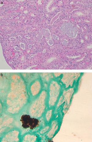 Renal biopsy findings in chronic phosphate nephropathy. (a) Case of chronic phosphate nephropathy with abundant intraluminal and intracellular calcifications in distal tubules accompanied by tubular atrophy and fibrosis (hematoxylin and eosin) and (b) a positive histochemical reaction with the von Kossa stain confirms that the tubular concretions are composed of calcium phosphate.