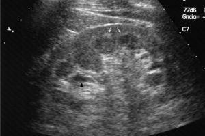 Ecografía abdominal, en corte oblicuo longitudinal del riñón izquierdo, que muestra hiperecogenicidad corticomedular (flechas blancas) y los quistes parapiélicos (flechas negras).