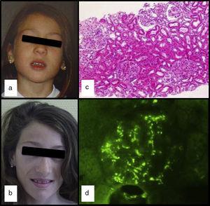 a y b) Evolución de la pérdida de grasa en la cara; c) Glomérulos con aumento de la celularidad mesangial, y afectación focal y segmentaria (H&E ×100) y d) Inmunofluorescencia granular mesangial con anti-IgA.