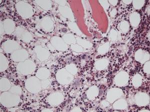 Imagen de médula ósea que muestra células inmaduras eritroides con signos de infección por el parvovirus B19 (hematoxilina eosina; x100).