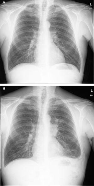 Imagen de radiografía de tórax posteroanterior A) previa al inicio del tratamiento con rituximab y B) tras el tratamiento y al diagnóstico del carcinoma de pulmón.