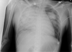 Chest X-ray revealing bilateral diffuse opacity, predominantly in the right hemithorax.