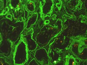 Immunofluorescence for κ-light chain – diffuse linear staining of the tubular basement membranes.