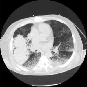 Hematoma intrapulmonar, áreas en vidrio deslustrado y zonas de patrón en empedrado por hemorragia pulmonar.