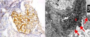 (a) Active lupus nephritis ISN/RPS class IV (A), NIH activity index (14/24) NIH chronicity index (4/12) showing focal segmental immunostaining for podocalyxin 2+ (left half of the glomerulus) with lost immunostaining in the right half of the glomerulus involved by leukocyte infiltration and endocapillary proliferation (original magnification ×400). (b) An electron micrograph for the same case showing marked diffuse fusion of podocyte foot processes (arrows) and subendothelial electron dense deposits (asterisks) (negative magnification ×22,000).