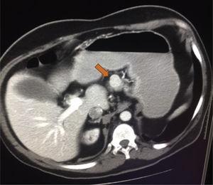 Lesión pancreática vista por tomografía axial computarizada en paciente con síndrome de Rubinstein-Taybi.