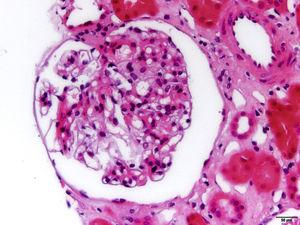 Microfotografía de uno de los 8 glomérulos que aportó la muestra en el que no se observan lesiones relevantes (H&E, ×40).