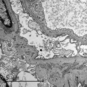 Imagen ultraestructural de la pared de un capilar glomerular en la que se observa fusión pedicelar irregular.