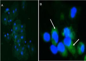 Detección de podocituria por inmunofluorescencia indirecta. A) Vista panorámica de sedimento urinario sin sinaptopodina (GC). B) Sedimento urinario en GF, se observa sinaptopodina positiva en podocitos. Magnificación: A ×100; B ×400.