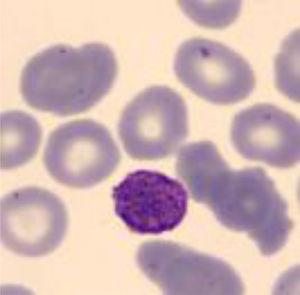 Extensión de sangre periférica con macrodismorfia plaquetar.