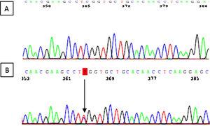 Resultado del estudio genético con la variante c.287C>T (p.Ser96Leu) identificada en el exón 2 de la paciente B) comprado con un caso control A).