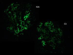 Inmunofluorescencia directa: depósito mesangial de IgA (+++) y de C3 (++).