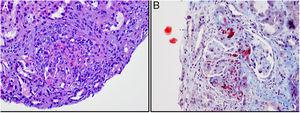 Biopsia renal. A) Glomérulo con engrosamiento de paredes capilares, necrosis fibrinoide y semiluna epitelial (hematoxilina-eosina). B) Esquistocitos en mesangio y luces y paredes de los vasos (tricrómico de Masson).