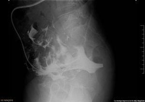 Peritoneografía fluoroscópica con salida de contraste por el extremo distal.