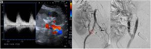 Ecografía Doppler (a) donde se demuestra flujo parvus tardus en la arteria renal. Se confirma estenosis de la arteria ilíaca en arteriografía (b), con posterior resolución tras tratamiento con angioplastia sin colocación de stent (c).