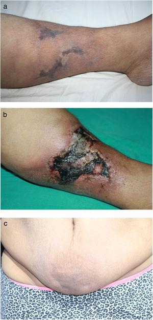 Dermatologic examination. (a, b) Violaceous, plaque-like subcutaneous nodules surrounded by livedo reticularis-like patches and necrotic ulcerations on legs. (c) Sclerotic subcutaneous nodules and peau d’orange appearance on infraumblical region.