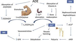 Possible mechanisms of hypercalcemia and kidney injury associated with the use of intramuscular vitamins A, D and E. ADE, intramuscular vitamins A, D and E. 25(OH)D3, 25-hydroxivitamin D. 1,25(OH)2D3, 1, 25-hydroxivitamin D. sCa2+, serum calcium. uCa2+, urinary calcium. aNDI, acquired nephrogenic diabetes insipidus. CKD, chronic kidney injury. AKI, acute kidney injury.