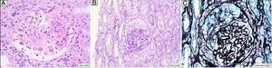 Biopsia renal. A) Técnica hematoxilina-eosina: lesión necrosante segmentaria con fibrina y restos de núcleos fragmentados. B) Técnica de PAS: semiluna epitelial. C) Técnica de plata: semiluna epitelial.