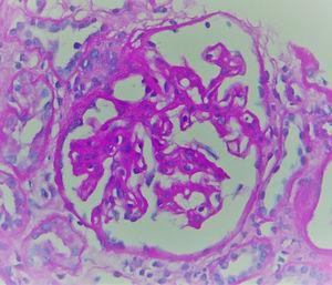 PAS, 200×: glomérulo con paredes capilares engrosadas, expansión mesangial y esclerosis segmentaria con adherencias a la cápsula de Bowman.