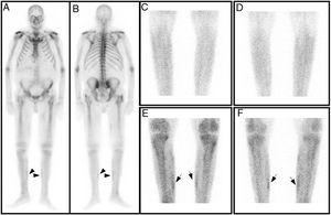 Gammagrafía ósea de cuerpo completo anterior (A) y posterior (B). Imágenes planares precoces de piernas (fase vascular) anterior (C) y posterior (D), no evidenciándose hallazgos gammagráficos significativos. Imágenes planares tardías (fase ósea), anterior (E) y posterior (F), se observa mínima hipercaptación del trazador en región medial de ambas piernas.