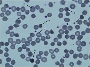 Photomicrograph of standard May-Grünwald Giemsa stained peripheral blood smear (100×) of the patient III-1 showing spherocytes (a), Howell-Jolly bodies (b) and basophic stippling of erythrocyte (c).