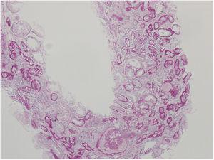 Pathology picture of the affected kidney biopsy in the father (II-2) of the probands: diffuse interstitial fibrosis and tubular atrophy with scarce interstitial infiltrate, and glomerulosclerosis (Perodic acid-Schiff, 100×).