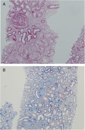 Pathology picture of the affected kidney biopsy in the family member (II-3): (A) Segmental glomerulosclerosis and pericapsular fibrosis accompanied by interstitial fibrosis and tubular atrophy (Periodic acid-Schiff stain, 100×). (B) Marked tubular atrophy in medulla (Trichrome stain, 100×).