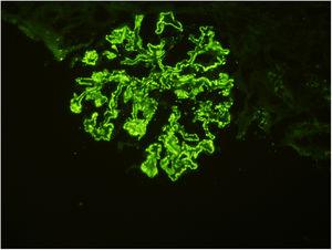 Granular Ig G deposition along glomerular basal membranes on immunofluorescence microscopy ×200.