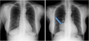 Radiografía de tórax previa al inicio y posterior al inicio en diálisis peritoneal.