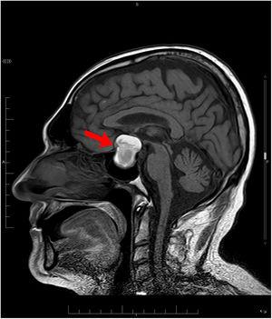 RMN sagital (T1). Macroadenoma hipofisario con signos de hemorragia intralesional subaguda y apoplejía hipofisaria (flecha roja).