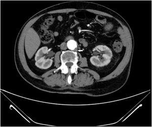 Trombosis aórtica Tomografía axial computarizada de abdomen tras la administración de contraste intravenoso en fase arterial, en la que se observa la dilatación de la aorta infrarrenal de 32 x 27 mm, con pequeño trombo intramural en su vertiente posteroizquierda de 6 mm de espesor (flecha).