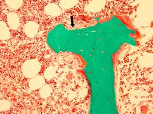 Adynamic bone disease. Depicts a classic bone biopsy featuring minimal osteoid (black arrow) and nearly no activity of osteoblasts or osteoclasts. Image courtesy of Avudai Maran, PhD and Bart Clarke, MD – Biomaterials and Histomorphometry Core Lab, Mayo Clinic, Rochester, MN.