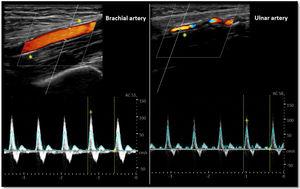 Doppler mode arterial evaluation: Brachial (left) and ulnar(right) arteries are shown. Both arteries present triphasic waveform flow (note the correctly adjusted sample volume and doppler angle). The * represents vessel calcification (hyperechogenic areas).