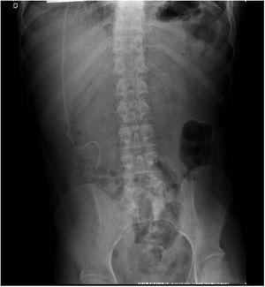 Tomografía computarizada toracoabdominal. Sección torácica y abdominal de la derivación ventrículo-peritoneal.