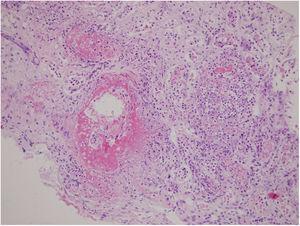 Renal biopsy showing diffuse tubulointerstitial inflammation and extensive necrosis destructing the normal structure of the tubuli and glomeruli on light microscopy (hematoxylin–eosin staining, original magnification 200×).