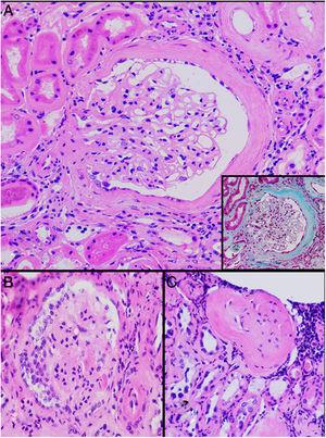 Alteraciones glomerulares en el caso clínico. A) Glomérulo con fibrosis pericapsular y ligero aumento de la matriz mesangial (en detalle se resalta la fibrosis pericapsular y la esclerosis perihiliar con la tinción de Masson) (H&E, ×400). B) Glomérulo con esclerosis difusa, disminución de tamaño del ovillo glomerular e «hiperplasia embrional» (H&E, ×400). C) Glomérulo con esclerosis total, rodeado de infiltrado linfocitario (H&E, ×200).
