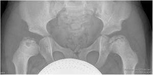 Radiografía de ambas cabezas femorales al diagnóstico.