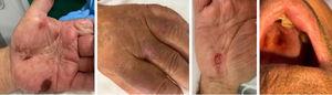 Lesiones en piel y mucosas posteriores a la administración de contraste yodado.