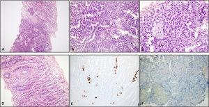 Renal tru-cut biopsy shows a papillary type renal cell carcinoma adjacent to the medulla (A). Tumor cells form papillary structures and foamy macrophages are present (B, C). Renal medullary tubular epithelial cells do not show viral inclusions (D). Anti SV-40 antibody is positive in the nuclei of renal medullary tubules (E). Note the SV40 negativity within the tumor cells (F).