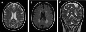 Axial T2 (A), Axial T2 FLAIR (B), Coronal T2 (C) – demonstrating disseminated punctuated and confluent WML on the periventricular and subcortical areas (patient 2).