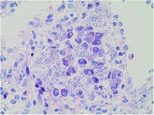 Biopsia esplénica, tinción de Giemsa. Microorganismos correspondientes con Leishmania de morfología redondeada u oval en el interior del citoplasma de los macrófagos/histiocitos.