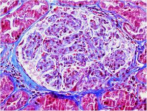 Tricrómico de Masson. Glomérulo con hipercelularidad endocapilar global, leucocitoclasia y fragmentación de hematíes en el penacho capilar próximo al polo vascular.