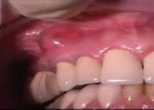 Absceso gingival.
