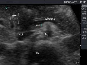 . Corte transversal en epigastrio: conducto de Wirsung, eje esplenoportal, vena cava inferior (vci), aorta (Ao) y cuerpo vertebral (CV).