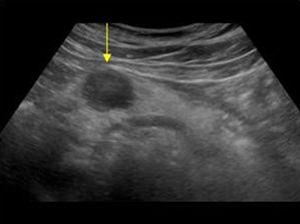 Corte transversal en epigastrio: carcinoma de páncreas, imagen hipoecogénica en la cabeza del páncreas.