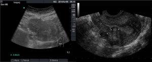 Imagen ecográfica de leiomiomas con sonda abdominal (izquierda, mioma subseroso) y transvaginal (derecha, uno submucoso y 2 subserosos).